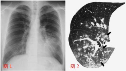 男子甲流并发症病毒性肺炎病例分析，四肢末端花斑与治疗探讨