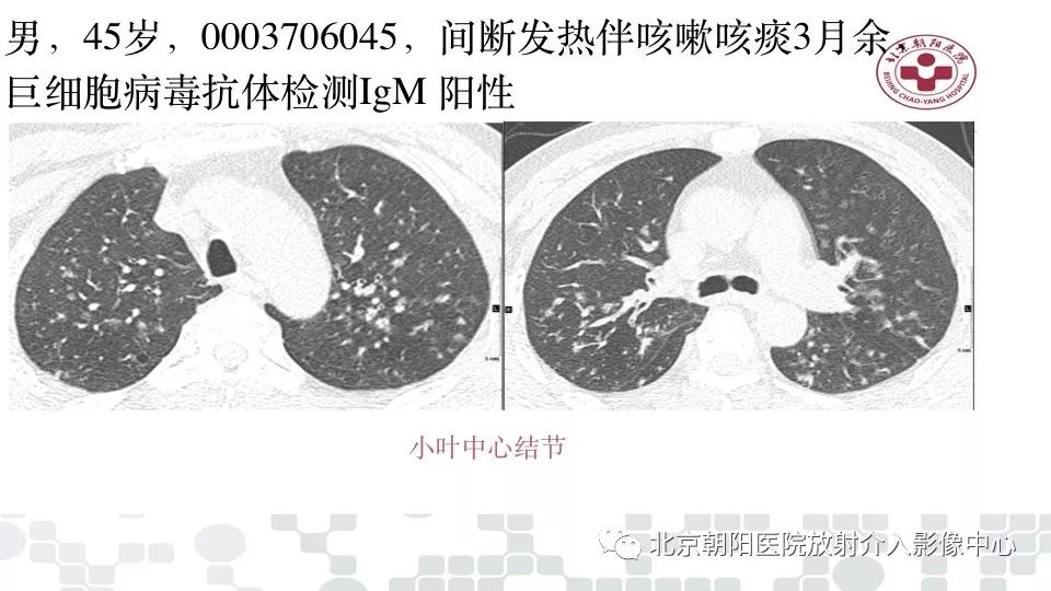 甲流后发烧引发病毒性肺炎，疾病演变与防治策略揭秘