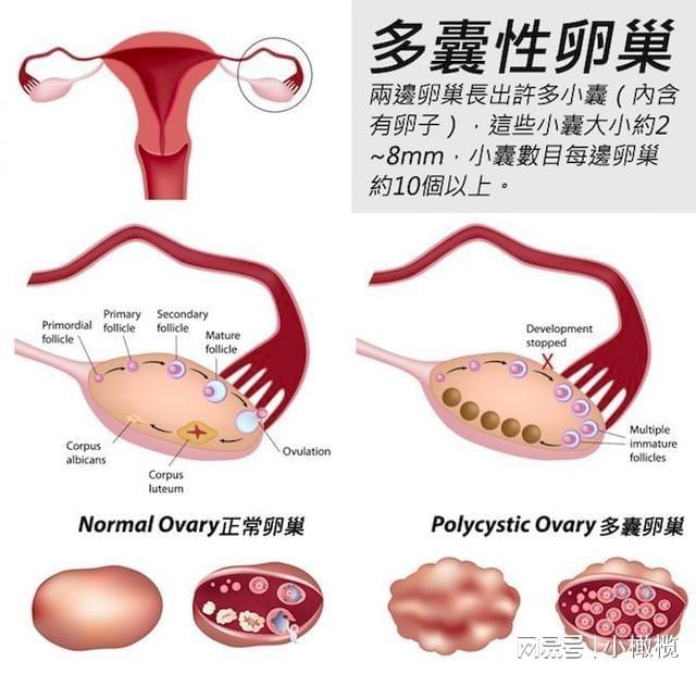 多囊，超越妇科病的范畴