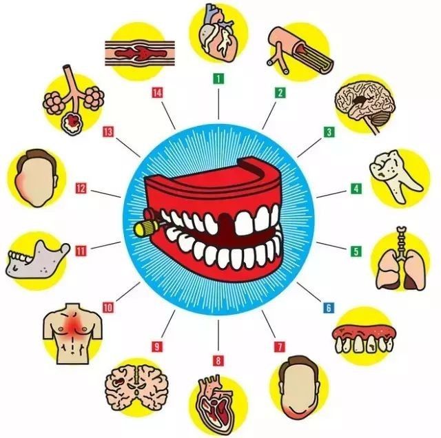 牙周病与脑卒中风险关联揭秘，预防与早期干预至关重要